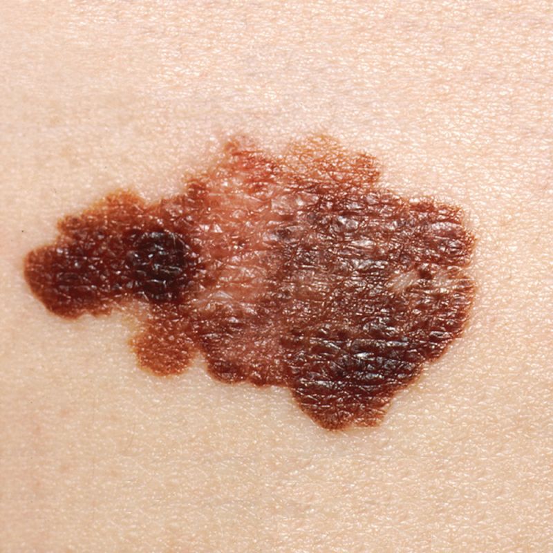 How deep each type of burn goes, and the types of skin cancer