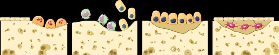 Bone cells breaking down old bone and building new bone