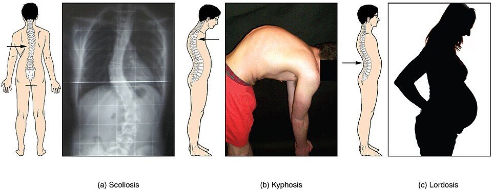Normal and abnormal spinal curvatures reference figure