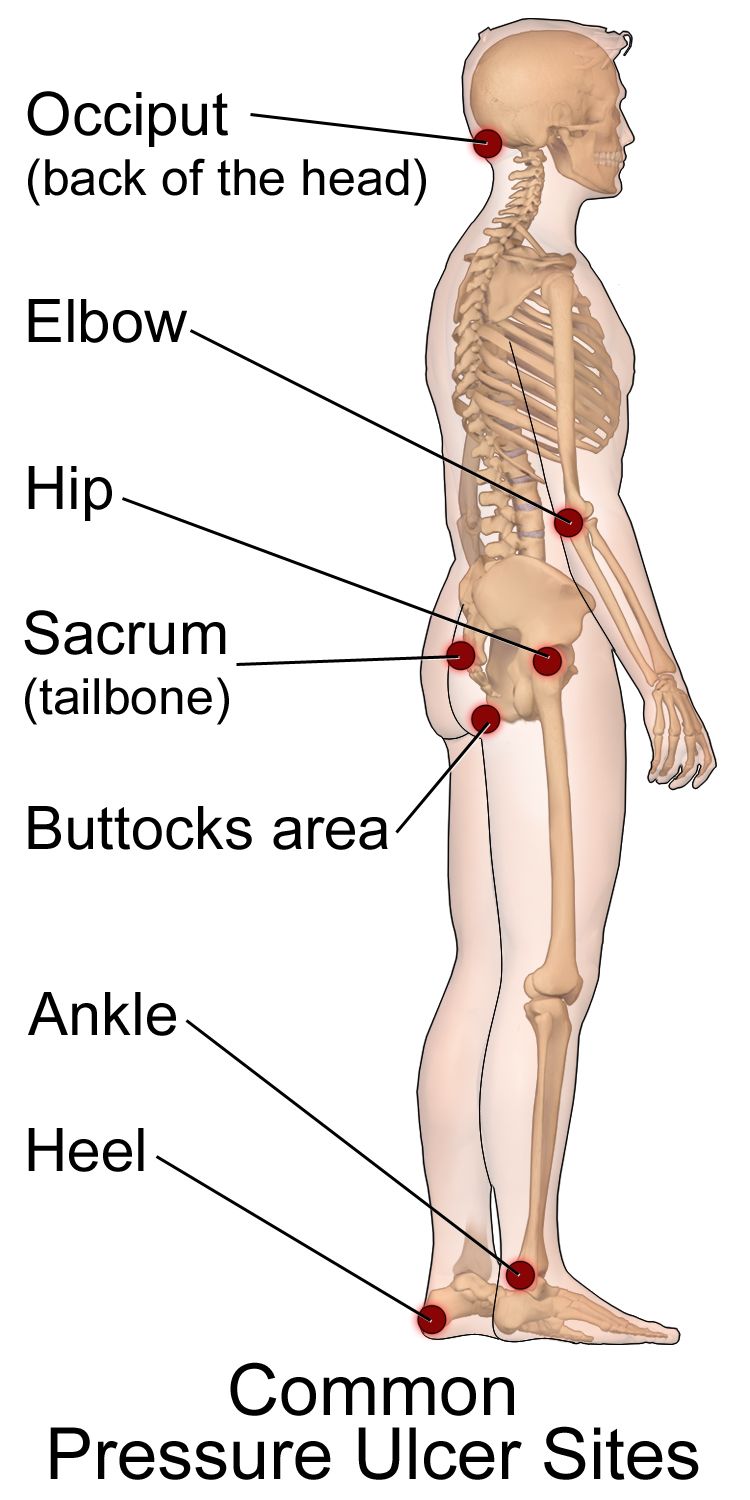 Pressure injury staging by depth of tissue loss, with the bony prominences most commonly involved.