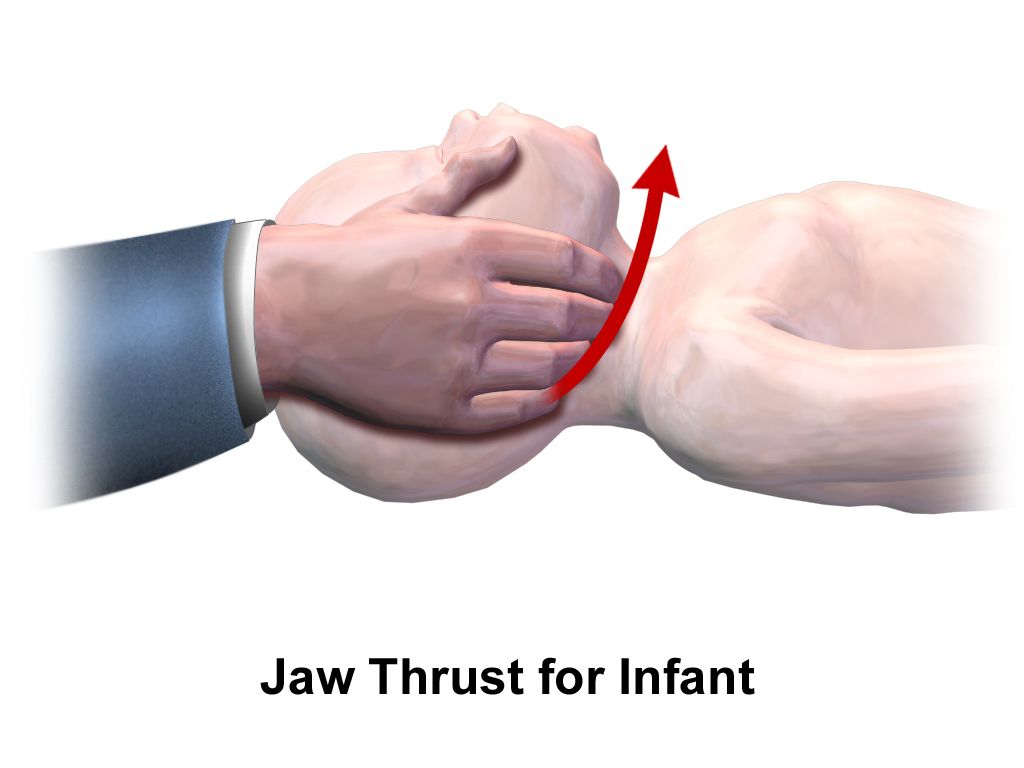 Infant in respiratory distress demonstrating nasal flaring, intercostal and subcostal retractions and use of accessory muscles compared with a calm infant