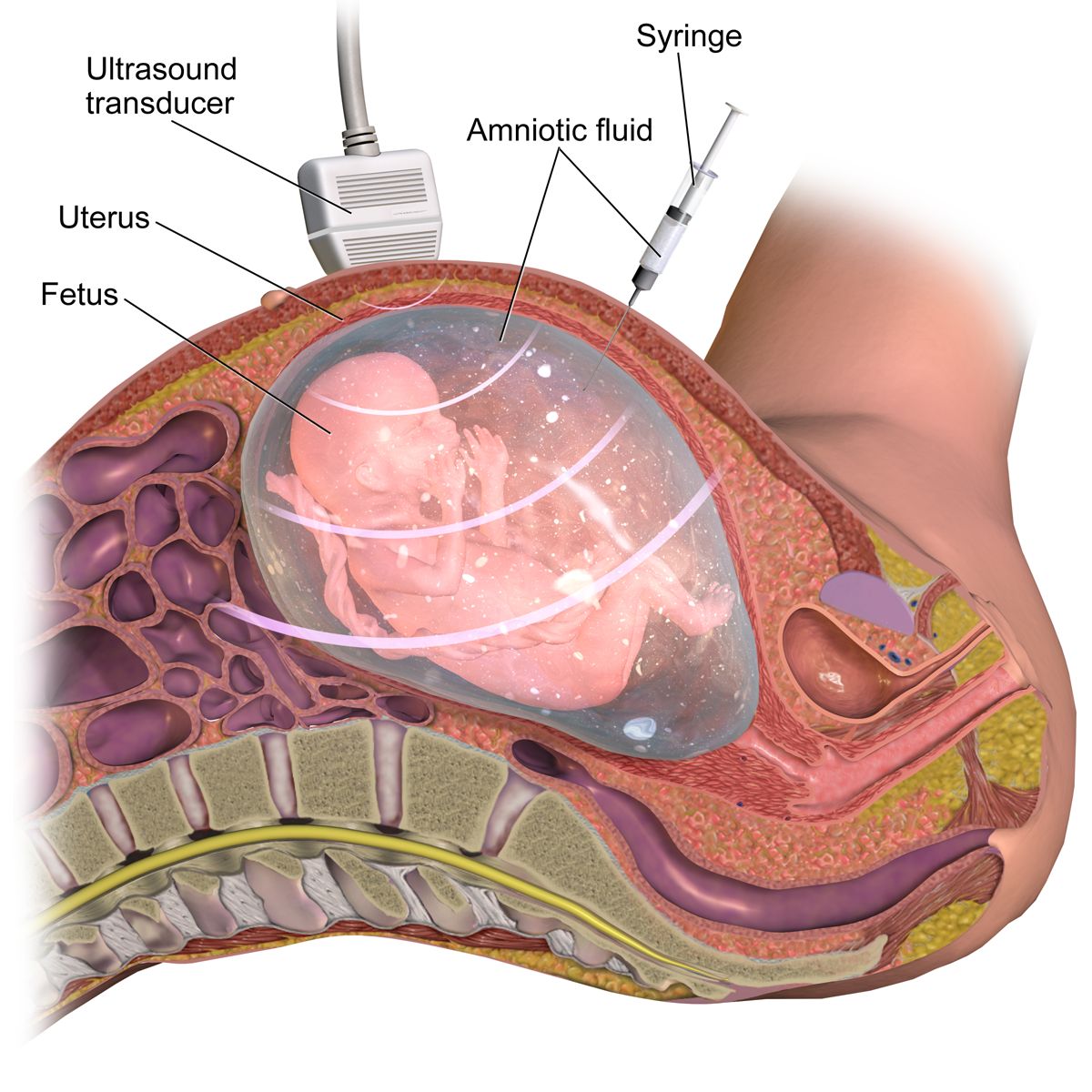 Illustration of ultrasound-guided amniocentesis showing the needle entering the amniotic sac away from the fetus and placenta