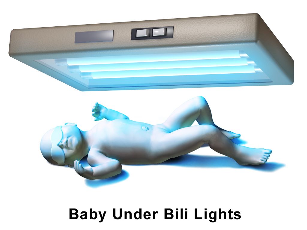 Newborn receiving phototherapy under blue light with protective eye shields in place and wearing only a nappy