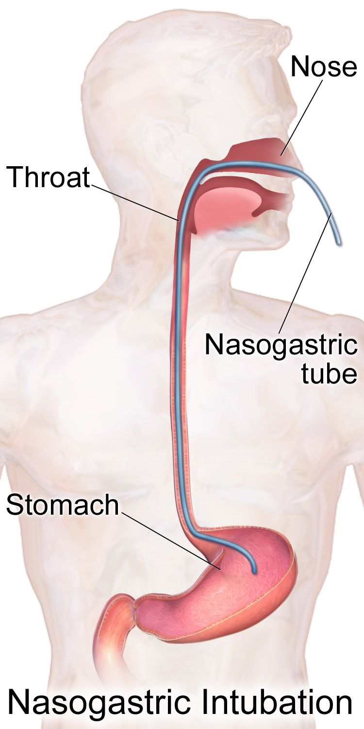 A small preterm infant nested in a humidified incubator with a temperature probe taped to the abdomen, a hat on the head and a nasogastric tube secured at the cheek