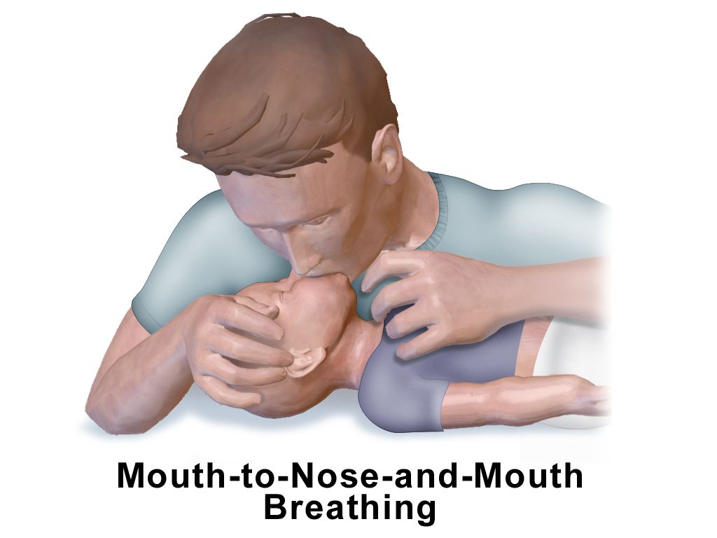 A clinician assessing an infant’s breathing and colour during an emergency evaluation, with the infant undressed on a resuscitation surface.