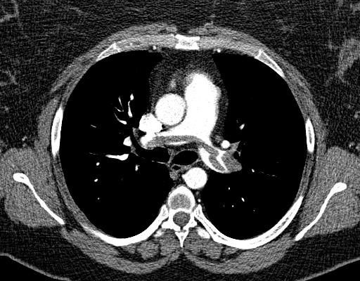 Saddle embolus on CT pulmonary angiography &mdash; the filling defect is clot occupying arterial lumen that should be filled with contrast.