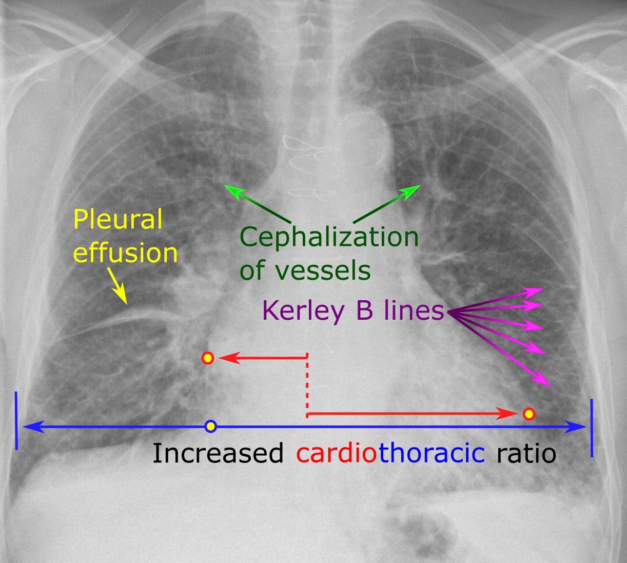 Blood backs up behind whichever ventricle is failing, which is why left failure floods the lungs and right failure floods the body.