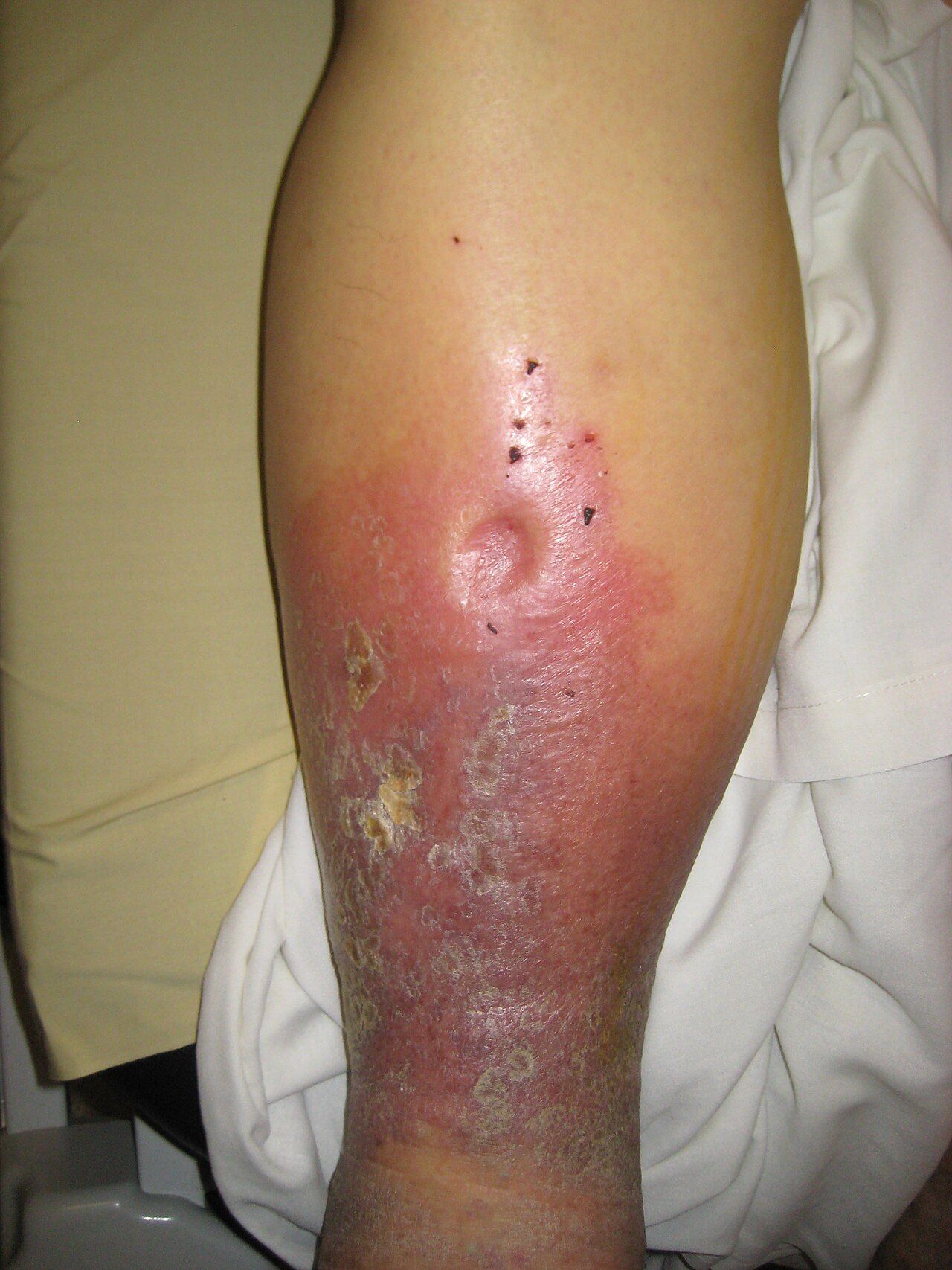 Dependent pitting oedema is a late sign of fluid retention, appearing only after several litres have already accumulated.