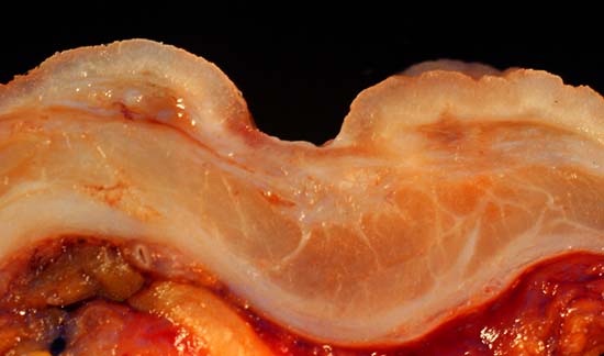 A peptic ulcer is a break through the muscularis mucosae, which is why it can bleed from an artery or perforate into the peritoneum.
