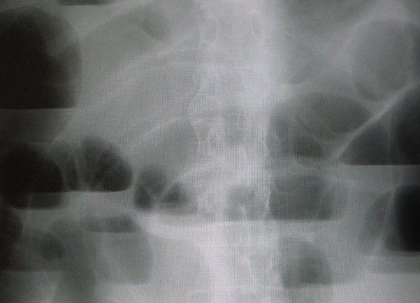 Dilated loops with air-fluid levels proximal to the blockage, and a gasless colon beyond it, are the imaging signature of mechanical small-bowel obstruction.