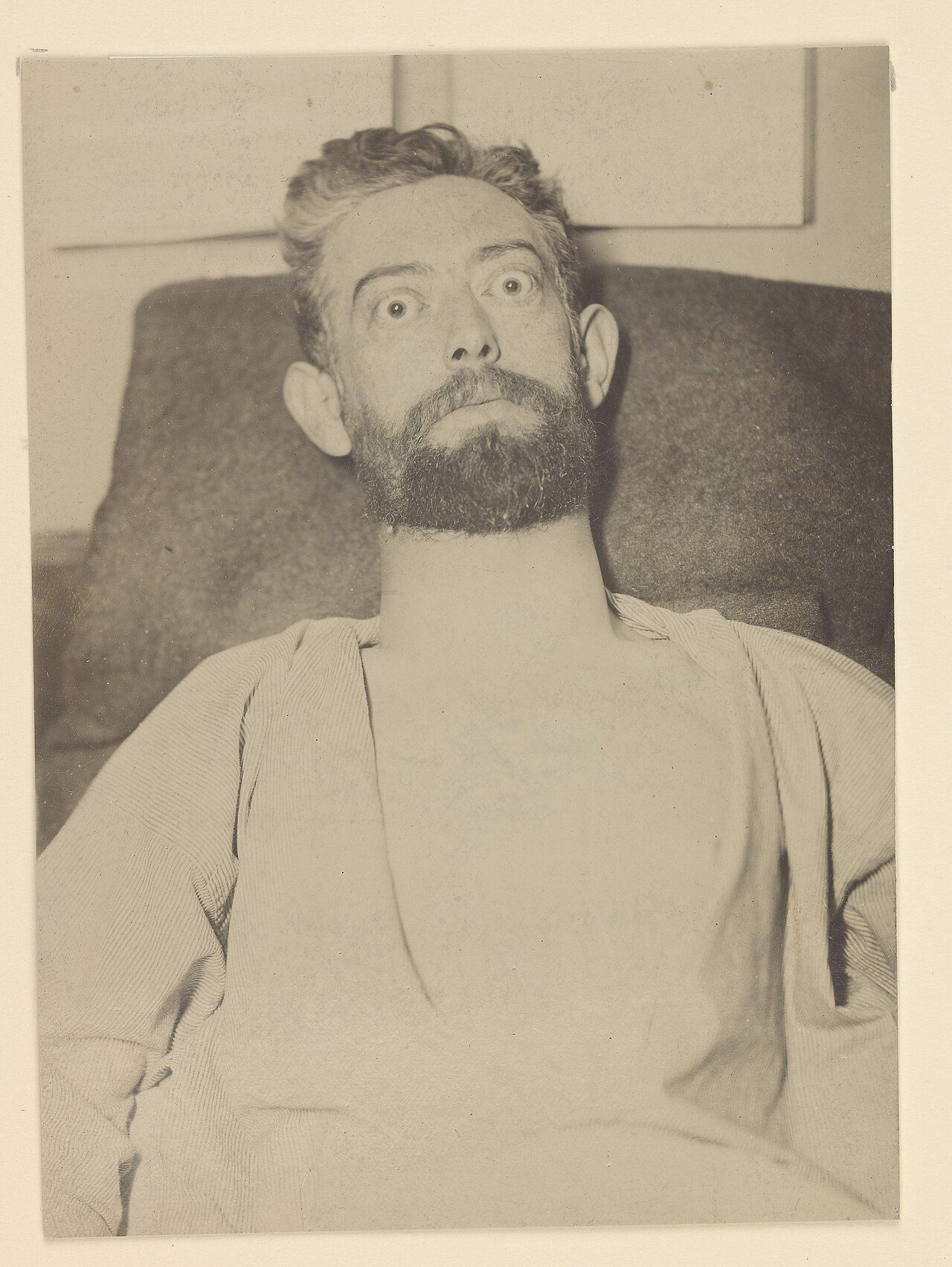 Diffuse goitre with exophthalmos and lid retraction — the thyroid-stimulating immunoglobulin of Graves disease acts on the gland and on the retro-orbital tissue at the same time.