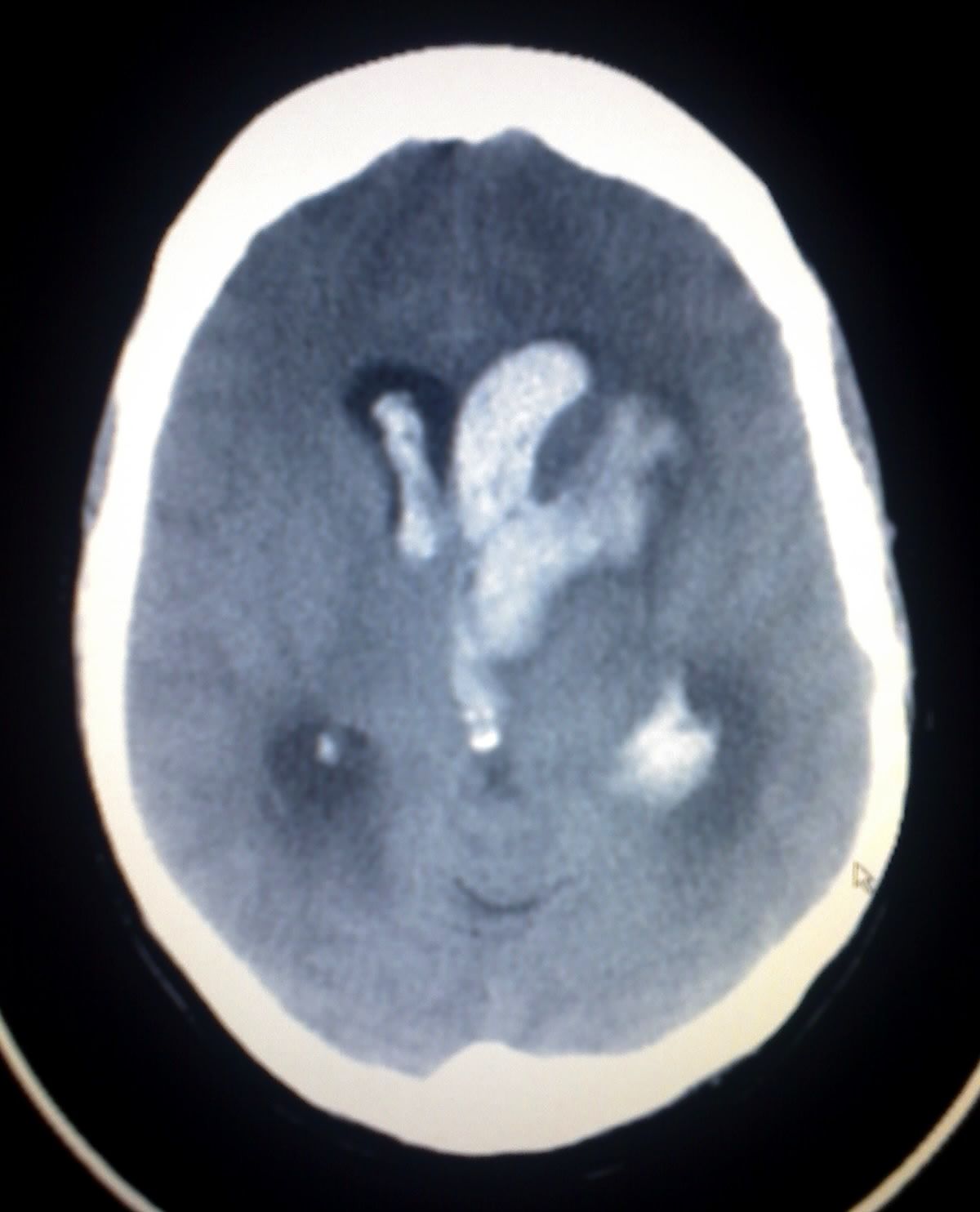 Acute blood is bright white on non-contrast CT, which is why the scan is obtained before any thrombolytic is even drawn up.