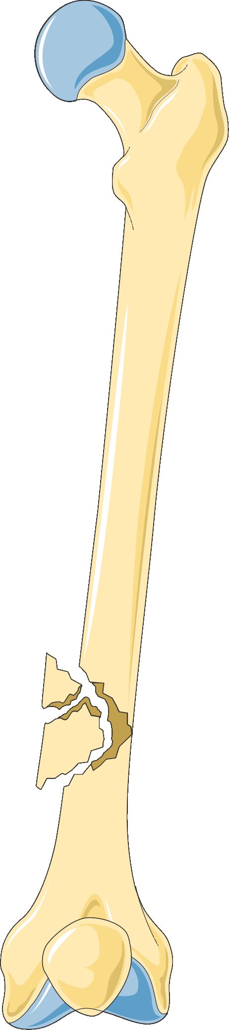 Illustration comparing fracture patterns including transverse, oblique, spiral, comminuted, greenstick, impacted and open fracture