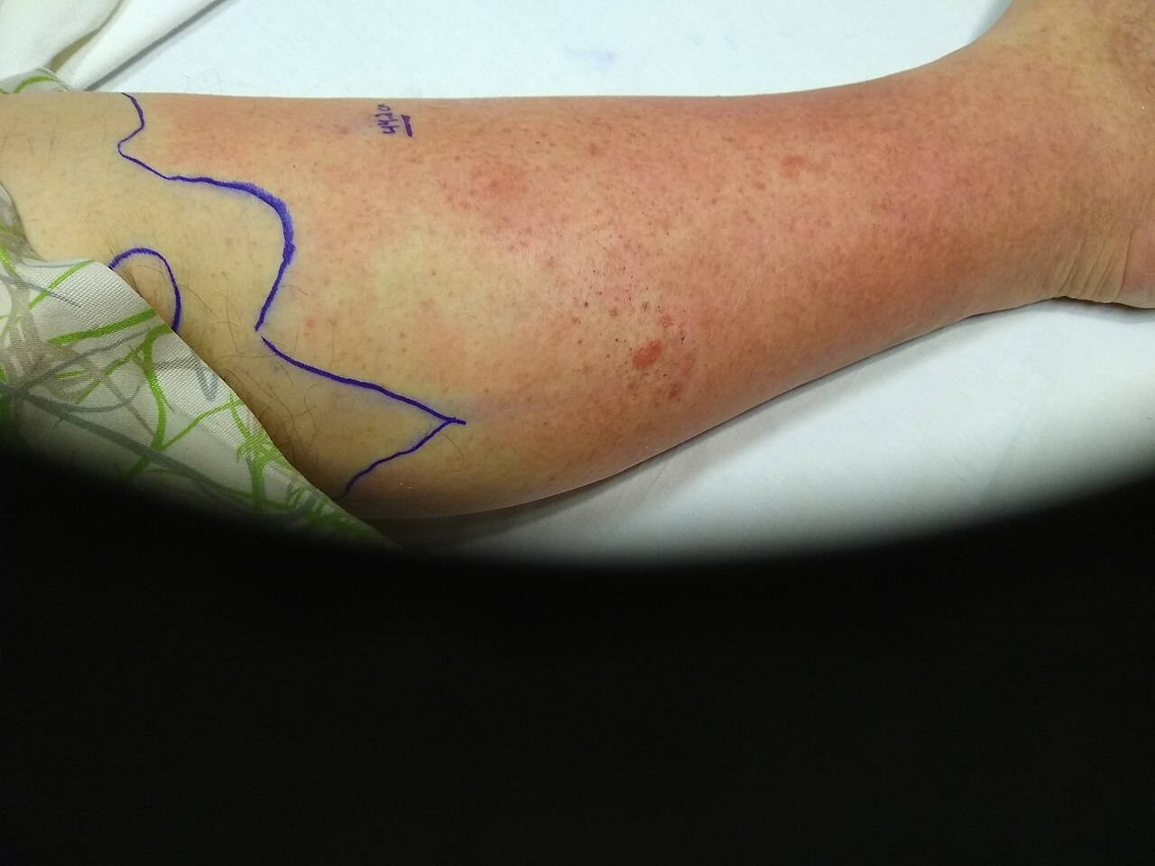 Cellulitis of the lower leg with the advancing margin outlined in ink — the cheapest and most useful serial assessment on the unit.