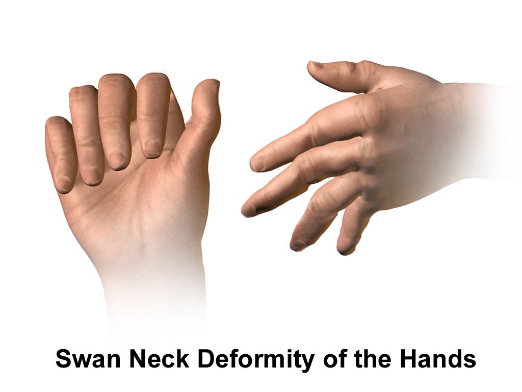 Hands of a patient with long-standing rheumatoid arthritis showing symmetric swelling of the metacarpophalangeal joints, ulnar deviation and swan-neck finger deformities