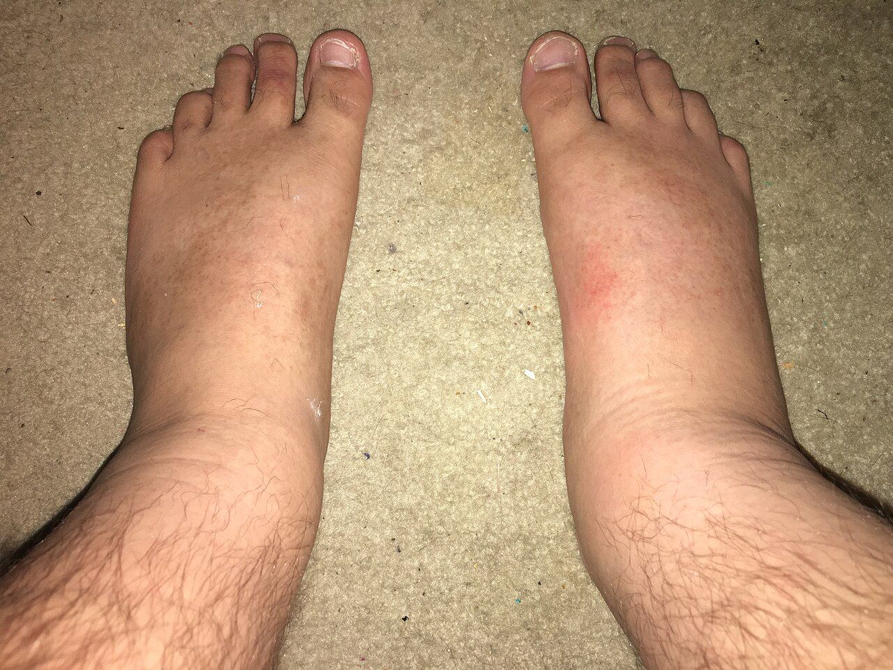 Cellulitis of the lower leg: unilateral, warm, tender, poorly demarcated erythema — marking and dating the border is how you measure response.