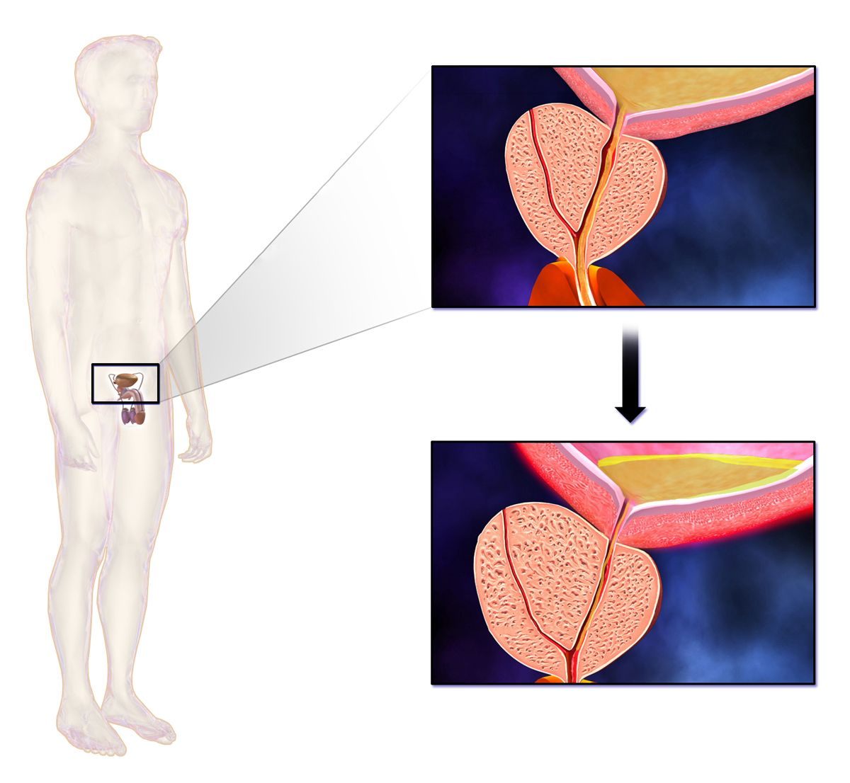 Diagram comparing a normal prostate with benign prostatic hyperplasia compressing the prostatic urethra and distending the bladder
