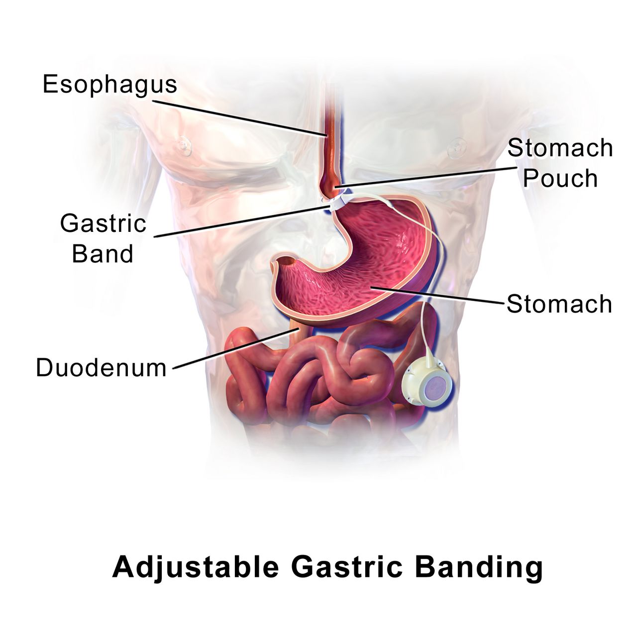 Surgical team performing a laparoscopic abdominal operation with instruments inserted through small ports and the field displayed on a monitor