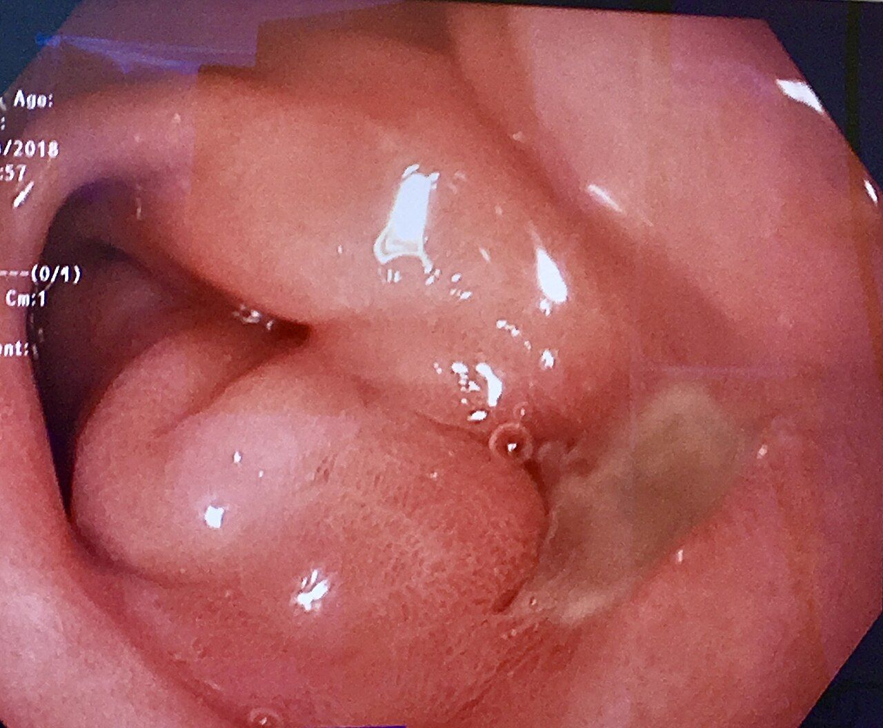 A peptic ulcer eroding the mucosa — the depth of the defect is what separates an erosion from an ulcer and an ulcer from a perforation.