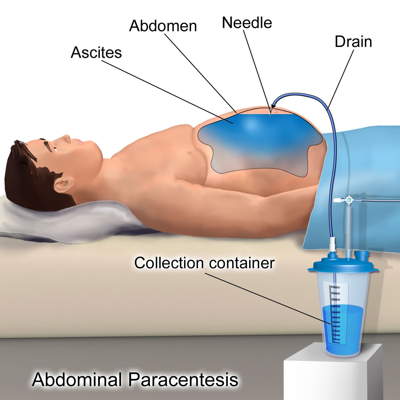 Illustration of abdominal paracentesis showing a supine patient with a needle placed through the abdominal wall to drain ascitic fluid into a collection container