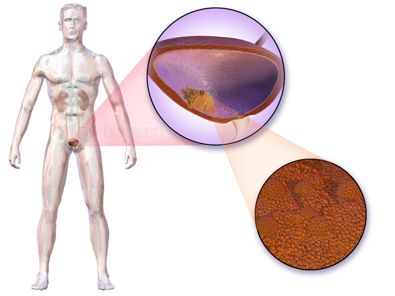 Labeled diagram of the urinary system showing both kidneys, the renal pelvis, the two ureters, the urinary bladder and the urethra