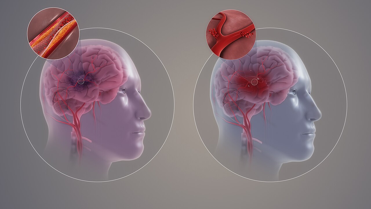 Ischemic versus hemorrhagic stroke — two mechanisms that share one clinical vocabulary of sudden deficits.