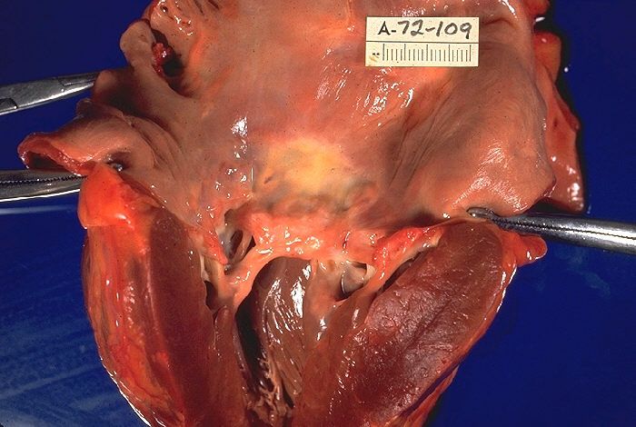Valve disorders reference figure