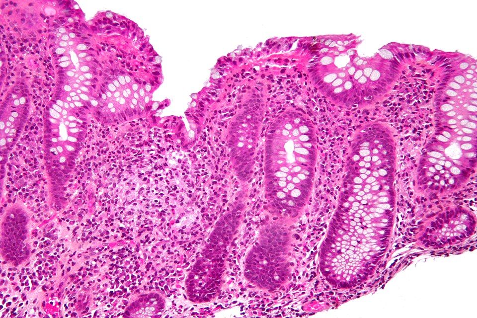 IBD reference figure