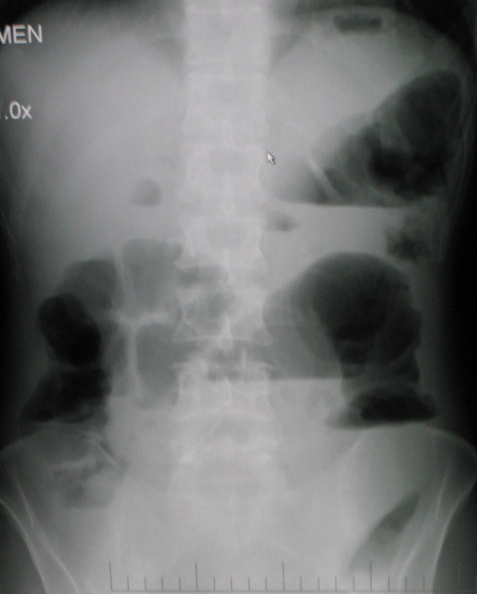Obstruction & bleeding reference figure