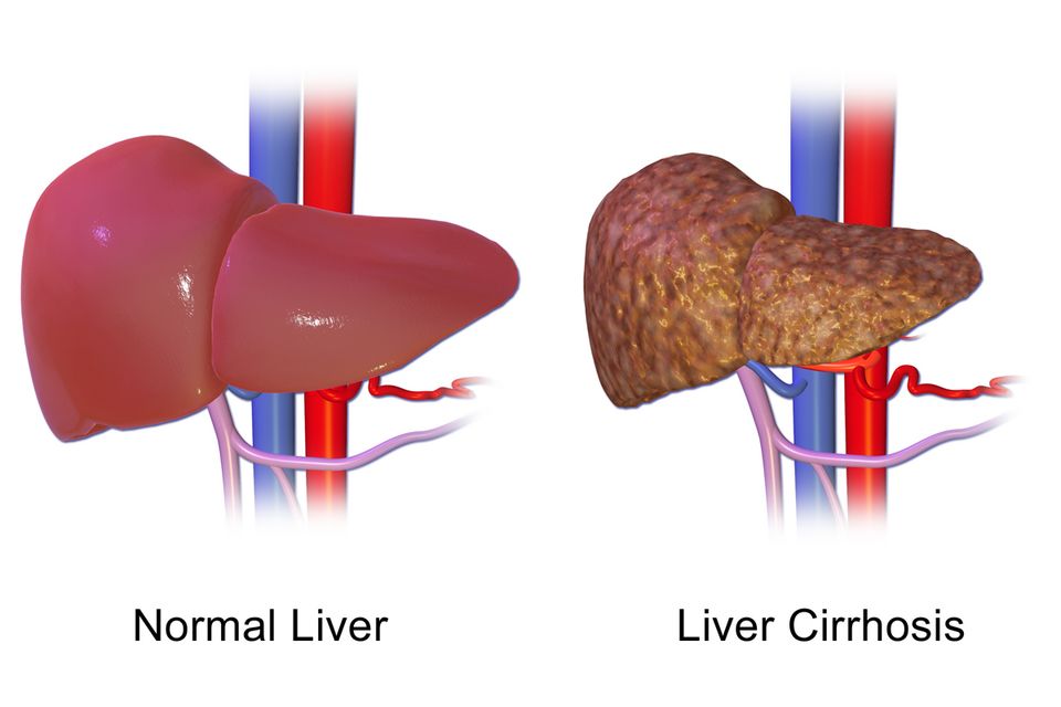 Hepatitis & cirrhosis reference figure