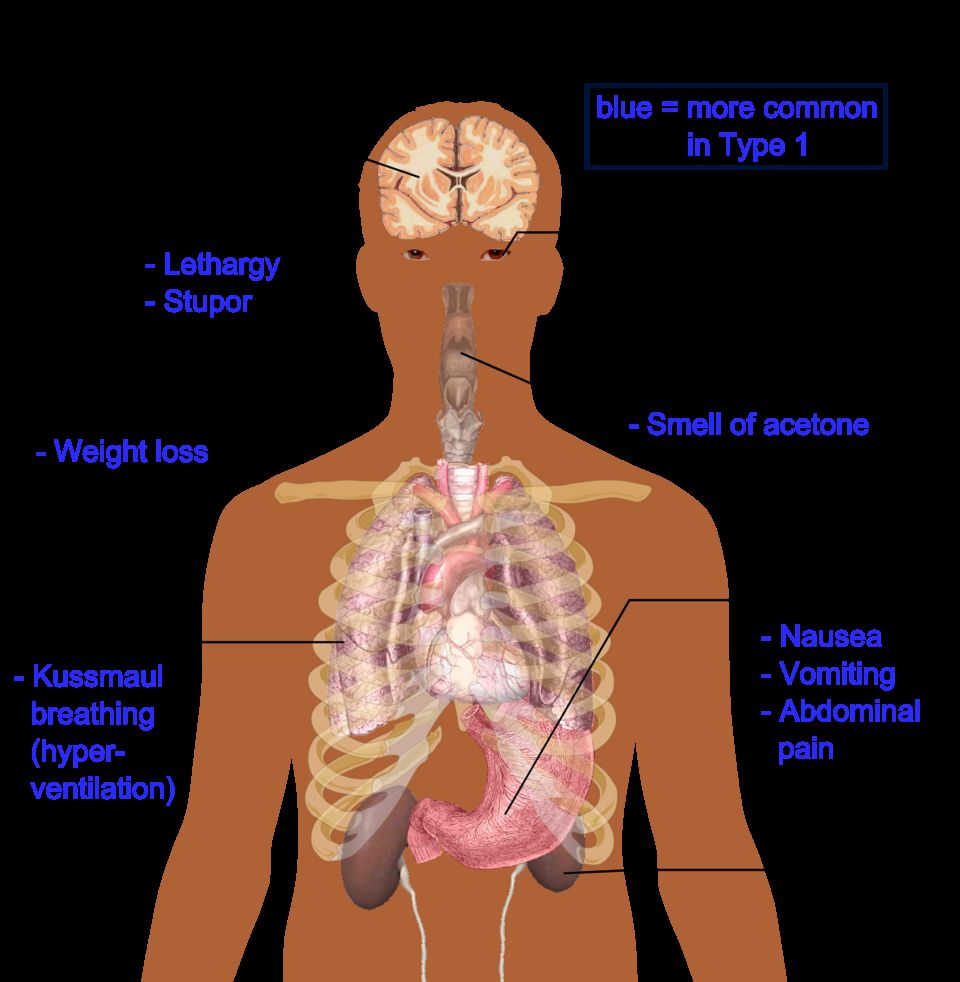 Diabetes mellitus reference figure