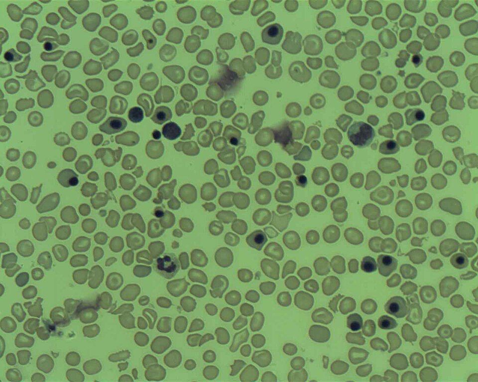 Blood cancers reference figure