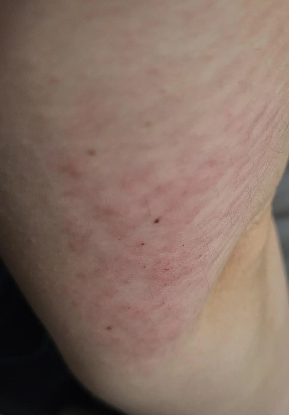 Hypersensitivity reference figure
