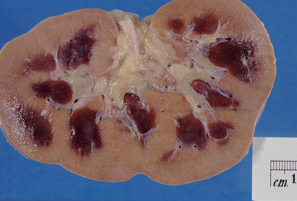 Acute kidney injury reference figure