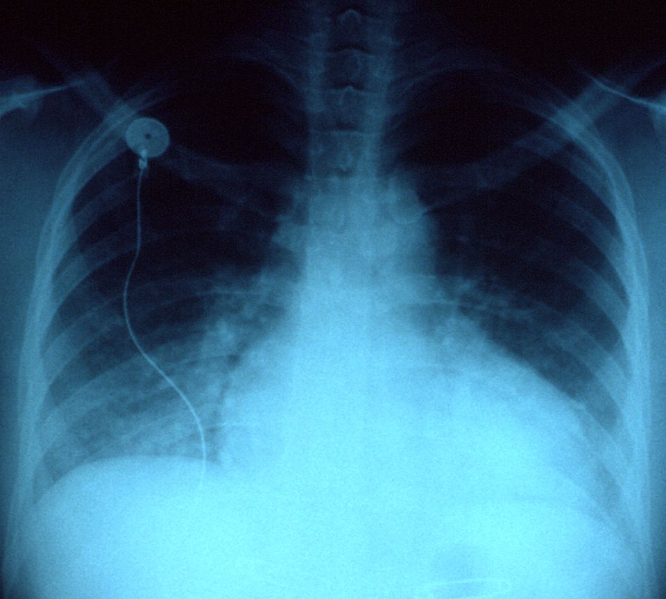 Reference figure for heart failure
