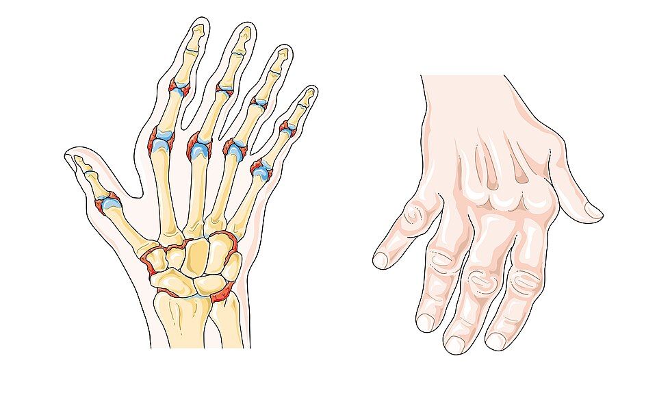 Reference figure on bone and joint disorders