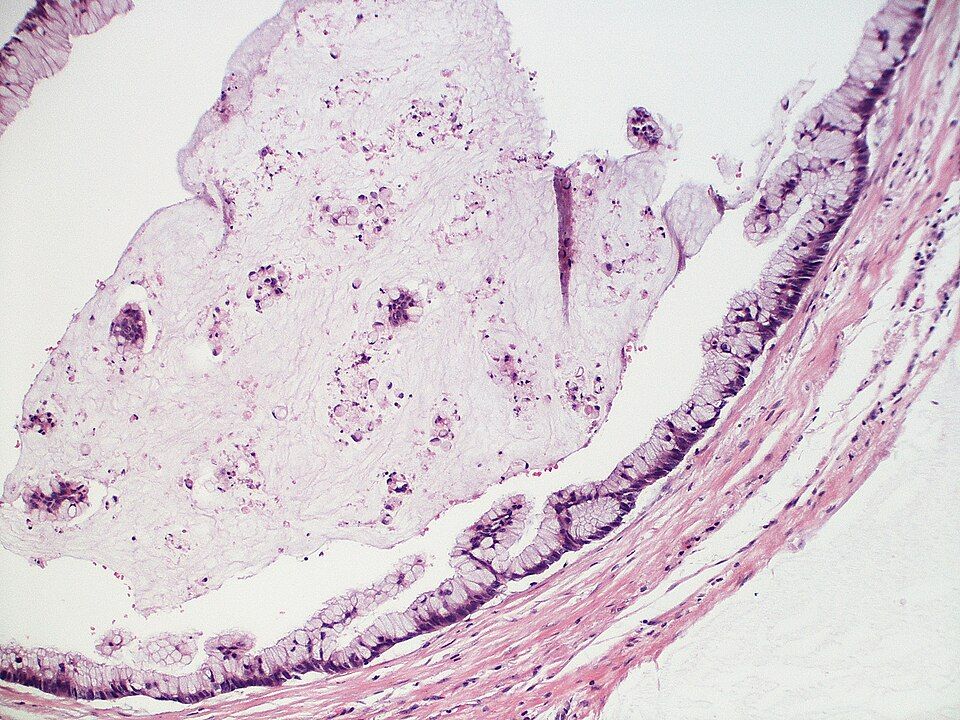 Microscope images comparing a benign tumor with a malignant tumor