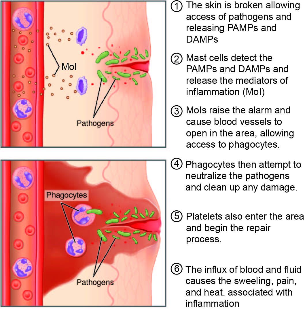 The inflammatory process, showing the chemical mediators released after tissue injury