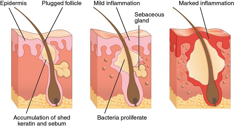 Reference figure showing how an acne lesion forms in a blocked sebaceous follicle