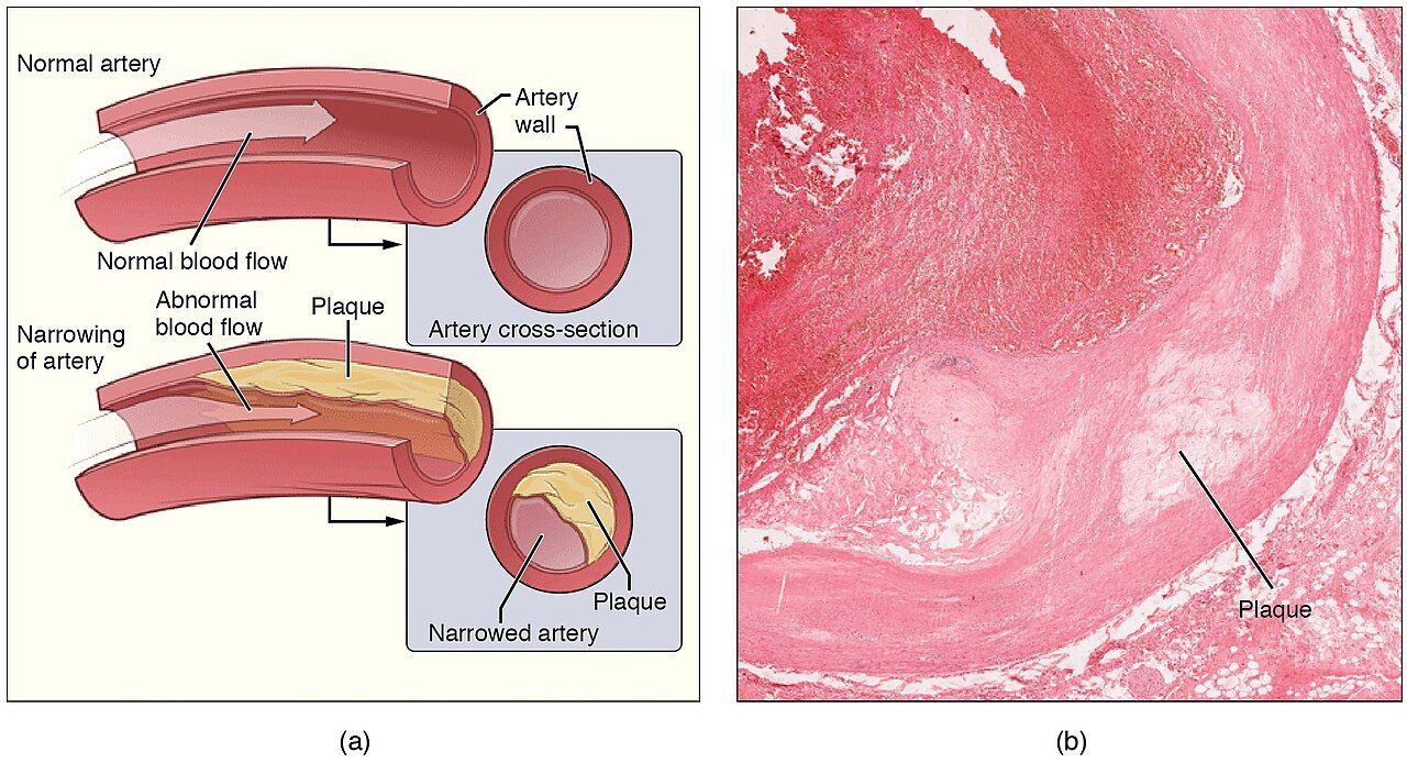 Atherosclerosis: fatty plaque narrowing an artery, promoted by chronic stress